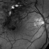 Retinal angiogram sequence
