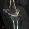 knee segmented