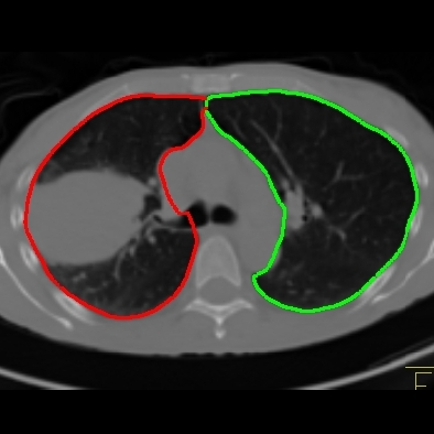 Lung segmentation axial