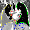 Lung segmented coronal
