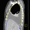 Lung segmented sagittal