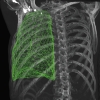 lung mesh